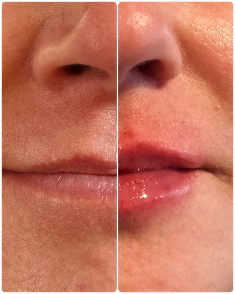Before and after Restylane Kysse lip filler treatment at Contour & Sculpt Aesthetics in Leander, TX