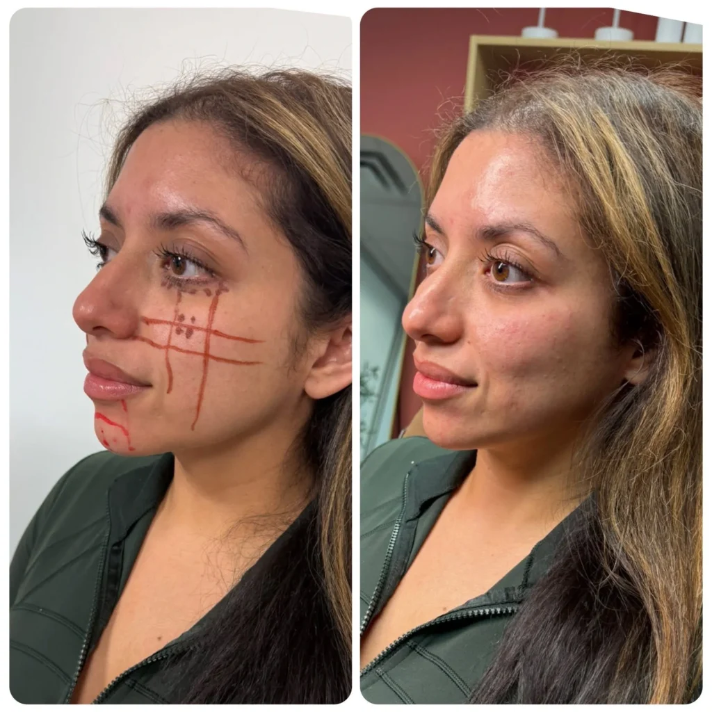 Side profile view of facial balancing Leander TX, demonstrating the mapping process and the final sculpted jawline and cheek results